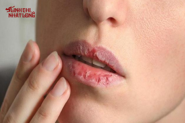 Khô miệng là biểu hiện thường gặp ở đái tháo đường type 1